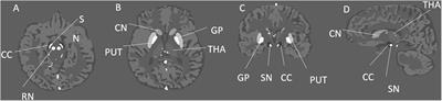 <mark class="highlighted">Iron Content</mark> in Deep Gray Matter as a Function of Age Using Quantitative Susceptibility Mapping: A Multicenter Study